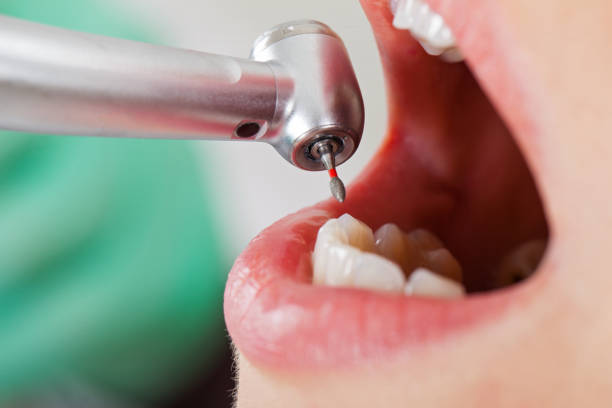 Urgent Tooth Repair in GA